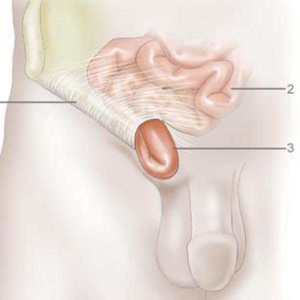 Ritual para tratar hérnia inguinal